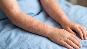 Lee más sobre el artículo ¡El sarampión ya encendió alarmas, banda! 🚨😷